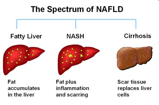 Non-Alcoholic Fatty Liver Disease (NAFLD) Treatment of NAFLD 1. Weight Loss: most effective intervention Via diet modification with or without exercise. 1. Seek gradual weight loss of <2lbs per week.