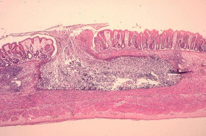 Flask-shaped crateriform ulcers