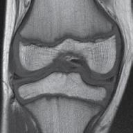 ACL on the femur where the tibial
