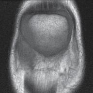 Slice Standardization The coronal slice was selected through the center of the patella where the patella was longest in the proximal to distal