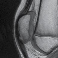 The sagittal slice was selected through the center of the patella where the patella was longest in the proximal to distal direction.