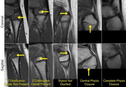 Slice Standardization The coronal slice through the center of the fibular styloid was selected.
