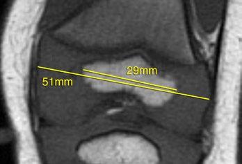 Slice Selection: The coronal slice through the center of the fibular styloid was selected.