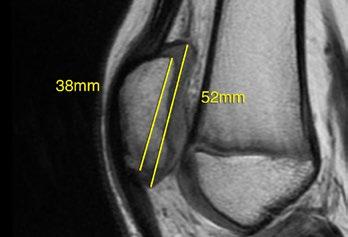 In this case, 73% of the patella is ossified (38mm/52 mm).