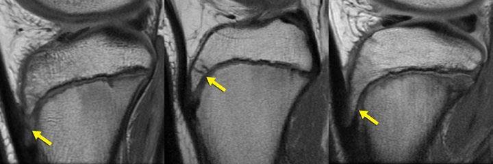 l Tubercle Ossification versus Crack As the tubercle apophysis appears (median age 11.8 years for boys and 10.2 years for girls), ossification can first be identified distally.