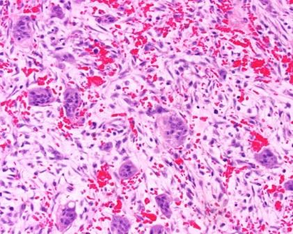 Aswath et al. 54 Figure 7: Photomicrograph shows connective tissue with plump fibroblasts, multinucleated giant cells and blood vessels (H & E, X400).