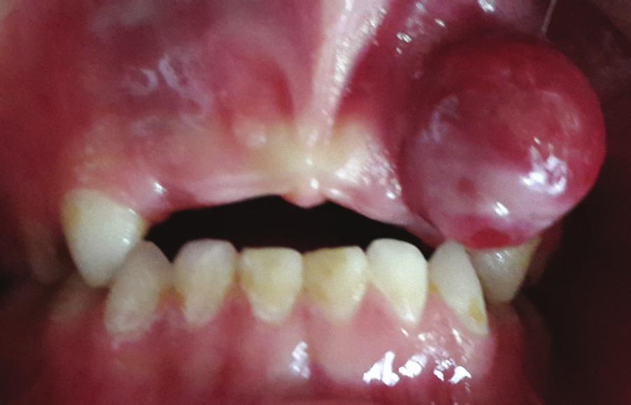 2 Figure 1: Intraoral preoperative view of lesion: a painless red enlargement of the maxillary attached gingiva extends to the alveolar mucosa between teeth #52 and 53.