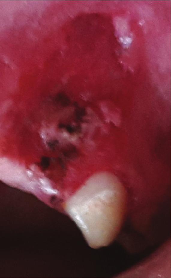 The patient was scheduled for surgical excision. Under local anaesthesia, the lesion was excised down to the periosteum (Figure 3).