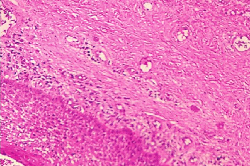 It is distinguishable from pyogenic granuloma and peripheral ossifying fibroma only on the basis of its unique histomorphology, which is the same as central giant cell granuloma [8, 9].
