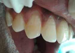 with periodontal disease.[1] It is the displacement of soft tissue margin apical to cementoenamel junction[2]and is very common in patients having good oral care standards as well.