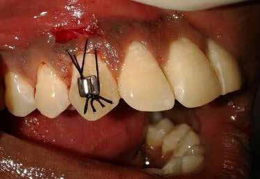 orthodontic tooth movements etc.[4,5] It is aesthetically undesirable condition that may lead to root dentine hypersensitivity and root caries.[6].