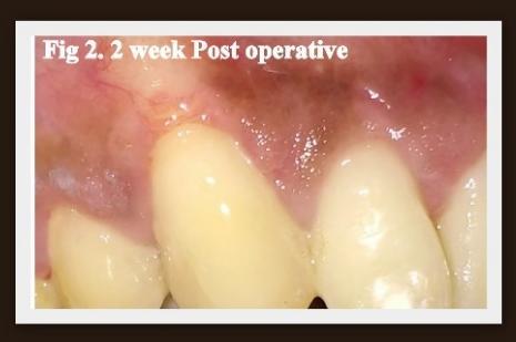 RESULTS The percentage root coverage obtained at 1 month postoperative visit was 83% with canine and 100% with lateral incisor. These results were sustained at 6months postoperative visit.