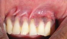 interdental soft tissue beyond the interproximal CEJ (Fig 6). Class II B-Associated with tooth malposition (Fig 7).