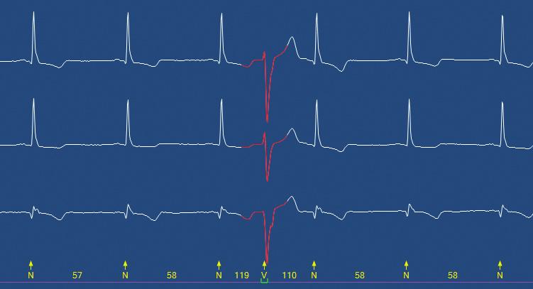 in even complex, noisy or unstable recordings. Algorithm Pathfinder SL has an intelligent analysis engine that analyzes the ECG waveform and beat shapes.