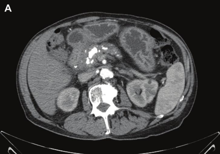 2 Case Reports in Medicine (a) (b) Figure 1: (a) CT scan prior to ERCP, illustrating evidence of chronic pancreatitis and pancreatic duct stricture, without associated pseudocyst, abscess, or