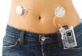 Types of Insulin Delivery Devices: Pumps Insulin delivery devices: Insulin Pumps Insulin pumps are usually recommended as a treatment by consultants for patients with Type 1 diabetes.