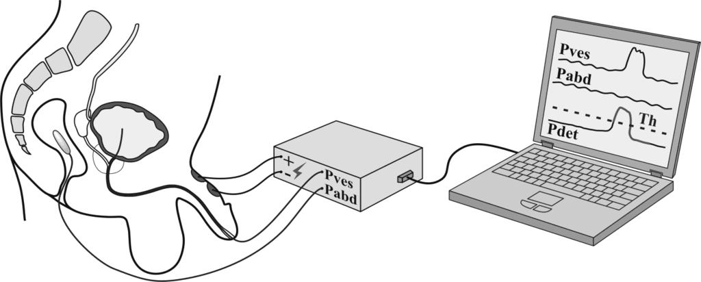 FIG. 1. Experimental setup for recording P ves and P abd with automatic, pressure activated stimulation control.