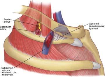 scalene or subclavius tendon, or the clavicle Young adults, athletic, weight lifting,