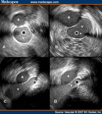 MAY-THURNER SYNDROME Many patients with MTS are asymptomatic Kibbe et al 1 reported series of 50 consecutive patients with abdominal CT for reasons unrelated to thrombosis 24% had greater than 50%