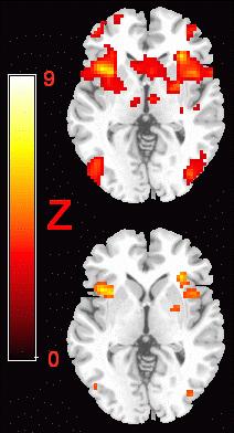 The fmri experiment Production of a Color-Coded Activation Map 20 The top and bottom images show the same data, with the top image showing a liberal statistical threshold ( Z>2.