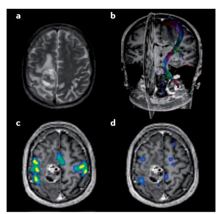 Applications of fmri Applications of multimodal MRI to brain lesion characterization.