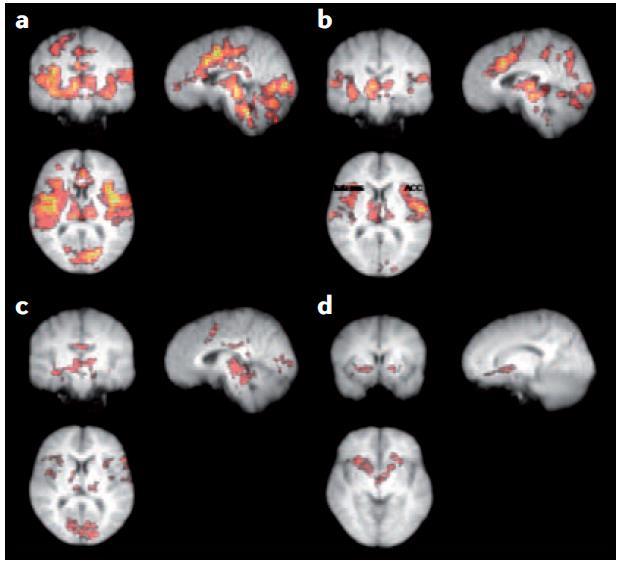 Applications of fmri Applications of multimodal MRI to brain lesion characterization.