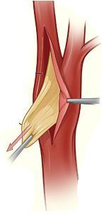 Carotid Artery Endarterectomy Exclusion of: patients with an acute
