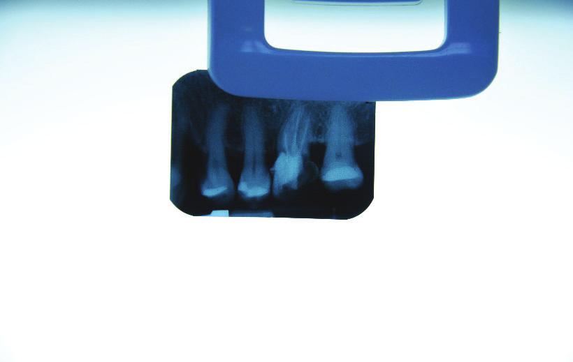 34 Weronika Lipska, Marcin Lipski et al. Fig. 11. Radiographic image of the endodontic treatment performed.