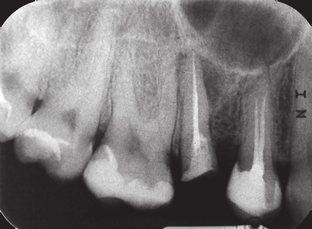 Clinical crown lengthening a case report 31 Fig. 5. X-ray image taken after the completion of endodontic treatment. Fig. 6.