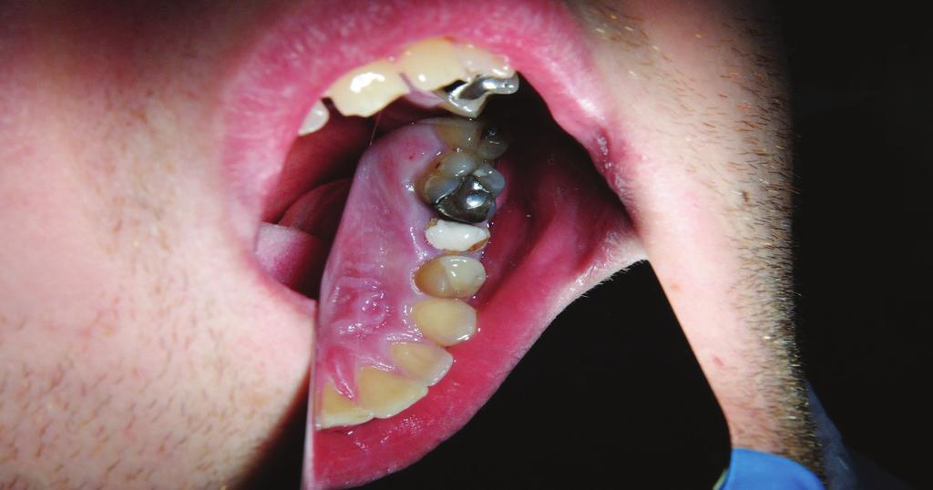 32 Weronika Lipska, Marcin Lipski et al. out the re-endodontic treatment, performance of the surgical lengthening of the clinical crown was scheduled first. Fig. 7. Image prior to surgery.