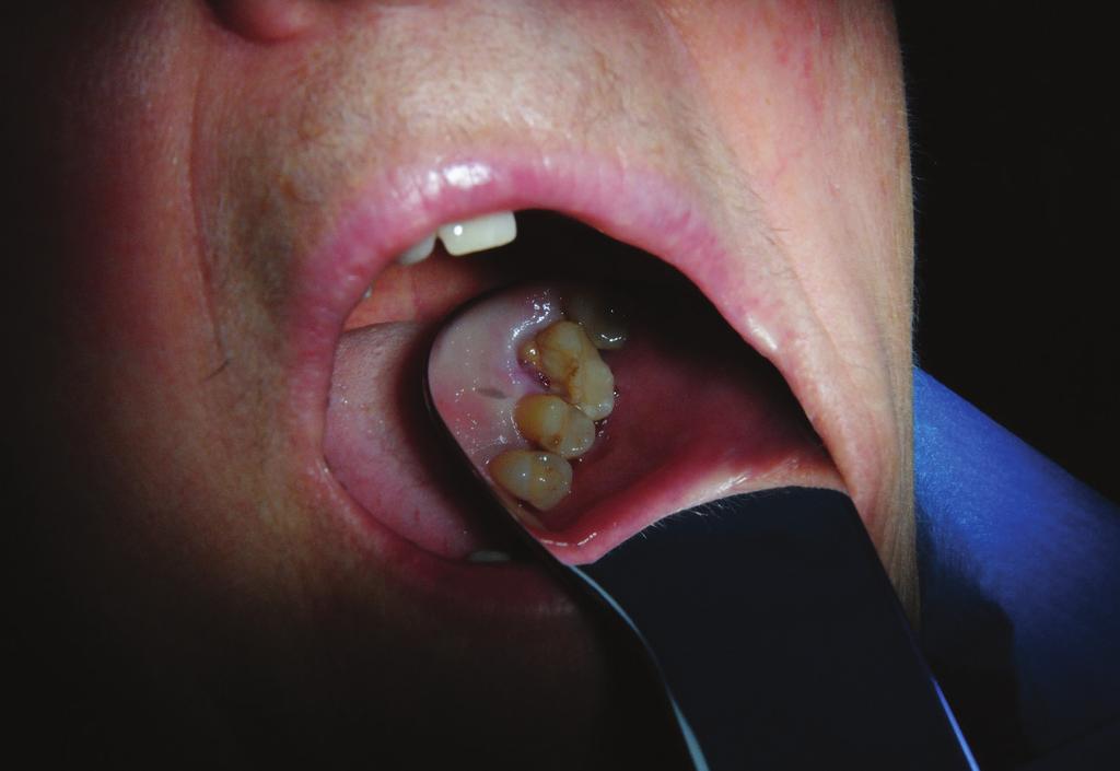 Tooth 26 with extensive composite filling and subgingival fracture of the palatal wall (Fig. 10).