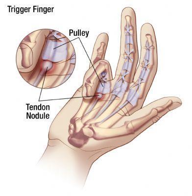 Trigger Finger and Trigger Thumb A Patient's Guide to Trigger Finger &