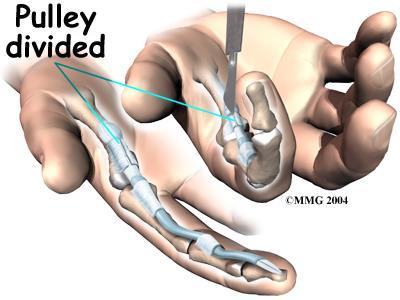 Surgery The usual solution for treating a trigger digit is surgery to open the pulley that is obstructing the nodule and keeping the tendon from sliding smoothly.
