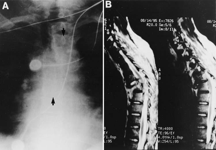 S. Shapiro, T. Abel, and R. B. Rodgers FIG. 5. Case 2. A: Anteroposterior radiograph documenting T3 4 fracture dislocation with translation.