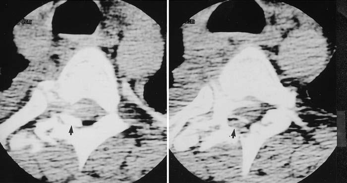 B: Sagittal MR images documenting T3 4 VB destruction with associated spinal cord compression. report, however, demonstrated interesting deformity of the cord with normal neurological function.