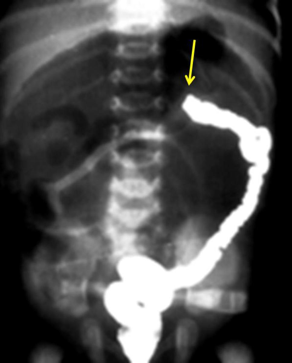 Fig. 5: Small intestine atresia : small intestine distension without gaz in large intestine area Fig.