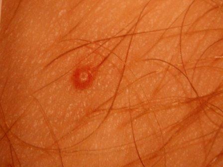 Molluscum Contagiosum Molluscum contagiosum is the most common infection in humans. It is caused by a poxvirus and is spread through direct skin to skin contact.