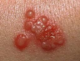 HSV infections are recurrent and the virus remains permanently harbored in the body.