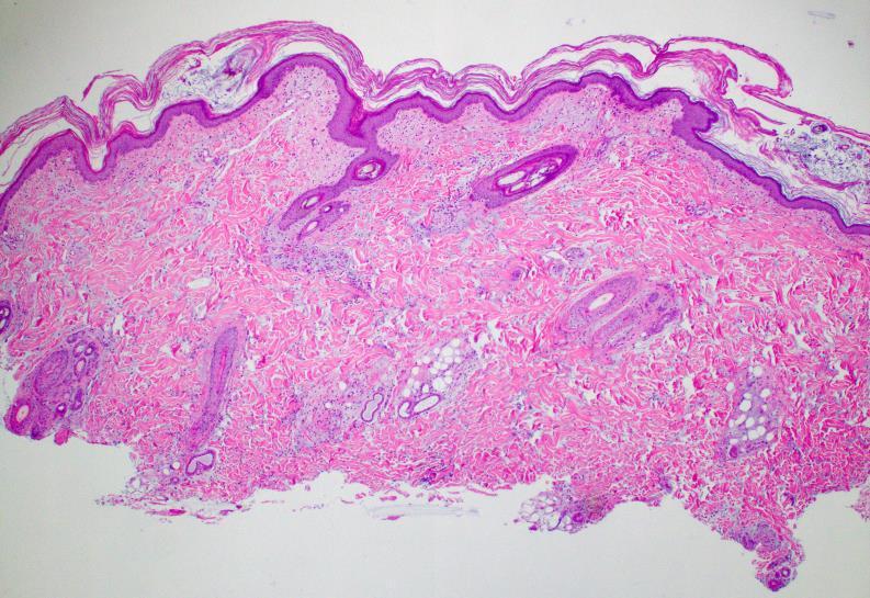 Figure 6. Figure 7. Clinical history: The patient presented for evaluation of sudden worsening of skin lesions over a one week period.