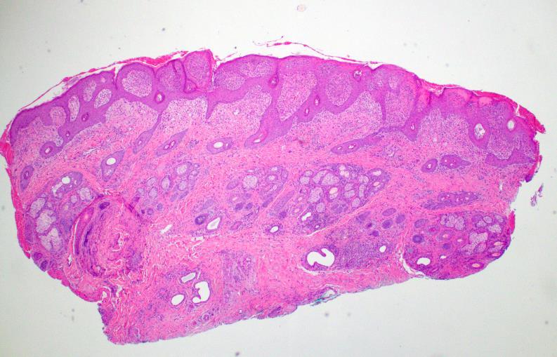 At that time skin biopsies were submitted by the referring veterinarian and described a mild eosinophilic perivascular dermatitis.