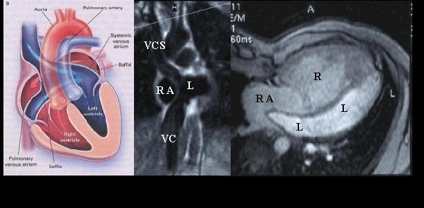 TGA: the atrial switch Pulmonary venous return: posterior from