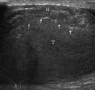 I Clinical photograph of the scrotum. T t o T Fig. 2a Longitudinal US image of the right hemiscrotum. Fig. 2b Transverse US image of the right hemiscrotum.