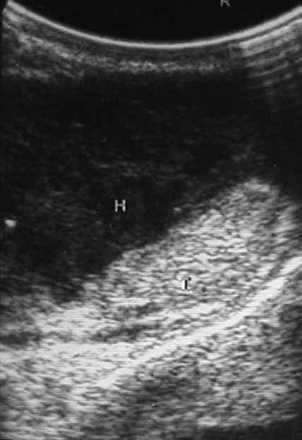 The scrotal skin was not thickened. Colour Doppler US (CDUS) (Fig. 2c) showed normal vascularity in the upper pole of the right testis but no vascularity in the lower pole.