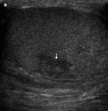 a heterogeneous echogenic mass (Fig. 7a). With time, it becomes complex with cystic components. An intra - testicular haematoma may mimic tumour, abscess, and infarct.