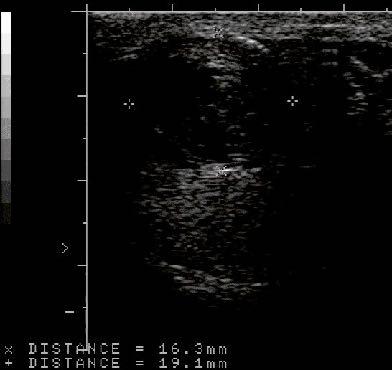 28 year. Growing left testis. No other symptoms.