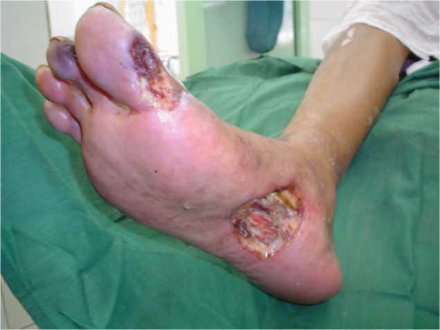 Foot complications The risks of lifetime