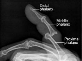 Volar finger PIP joint dislocations are extremely uncommon.