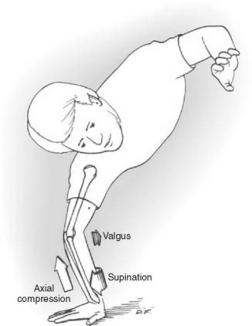 a hyperphysiologic valgus moment occurring to an extended