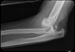 fracture after elbow dislocation, although