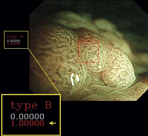 The image features are acquired from nuclear morphologies, and the pathology of the polyp is predicted in real time with its probability.